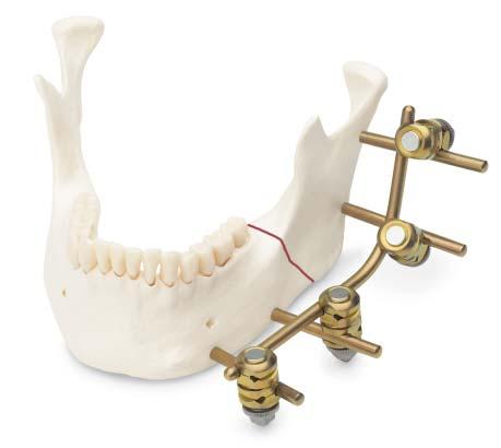 Alternative Frame Configurations Frame incorporating an Adjustable Parallel Pin Clamp As applied on a mandible with a fragment that