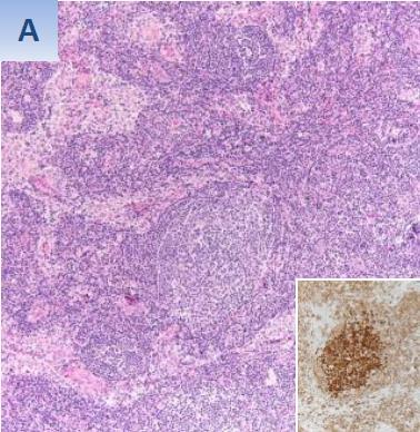 In situ follicular neoplasia (ISFN) Formerly: in-situ Follicular lymphoma, FLis Indolent clonal population High frequency (2-3% of patients ) Low rate of