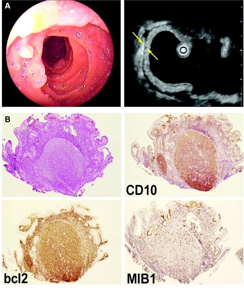 Duodenal-type FL Variant of FL Different from generic GI-tract FL Low grade (G1) BCL2 positive