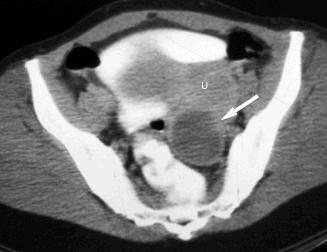 CT pelvis showing