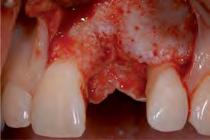 Following implant placement, the defect is filled with Geistlich Bio-Oss.