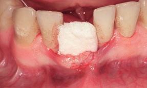 deficiencies in the esthetic zone where an easy and pain-free treatment solution is necessary to