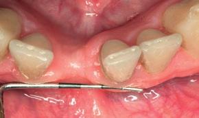 3 Occlusal view, healed site: measuring the defect before second stage surgery for soft-tissue