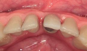 Generously released flap beyond the mucogingival line in the apical direction to ensure a