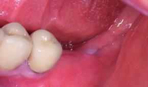 soft-tissue around dental implants with Geistlich Fibro-Gide in the