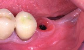 2 3 4 6 8 Baseline before implant placement showing the soft-tissue