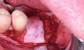 2 Implant surgery after implant placement showing the need for GBR.
