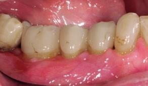 STAGED APPROACH AFTER IMPLANT PLACEMENT Ridge Preservation and