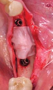 Geistlich Fibro-Gide in place augmenting buccal and crestal area of 3 and