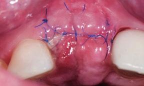 around a single implant in the esthetic area with
