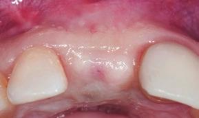 incisor with labial soft-tissue deficiency 3
