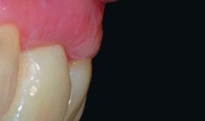 STAGED APPROACH AFTER IMPLANT PLACEMENT Thickening Soft-Tissue When