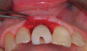 of soft-tissue around dental implants.