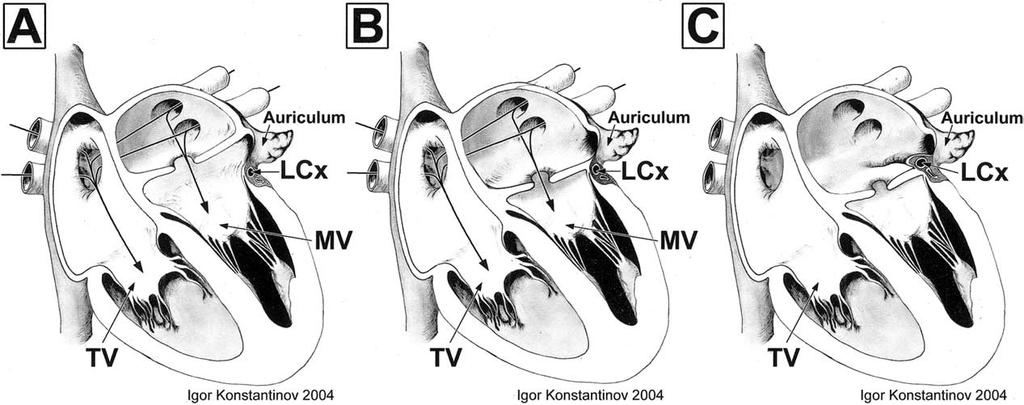 248 I. Konstantinov et al. Surgical Technique Figure 1 The morphology of each of these anomalies has distinct features of crucial importance to the surgeon.