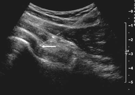 The sonographic appearance of the glenoid labrum has been described in a cadaveric model as a compact, hyperechoic, triangular structure with irregular hypoechoic clefts seen in the setting of a tear.