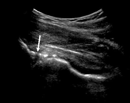 A B Figure 3. Anterior labral tear in a 50-year-old female patient.