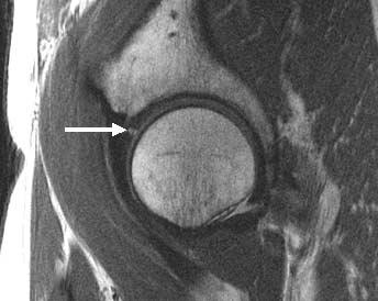 B, Sagittal high-resolution proton density fast spin echo surface coil MR image of the same patient showing the tear at the base of the anterior labrum (arrow).