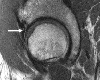 7,10 Labral tears can predispose patients to early osteoarthritis and can occur in conjunction with additional chondral injuries.