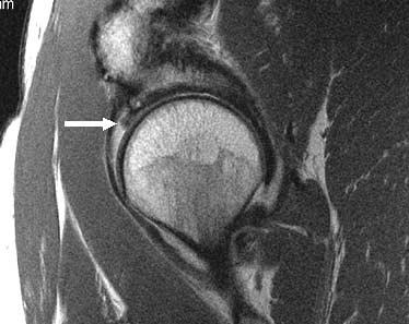 Sofka et al A Figure 5. Anterior labral tear in a 42-year-old female patient.