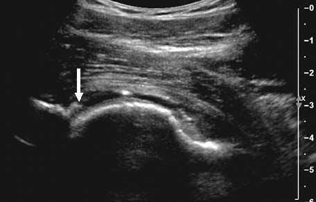 B, Sagittal high-resolution proton density fast spin echo surface coil MR image of the same patient showing the torn anterior labrum (arrow).