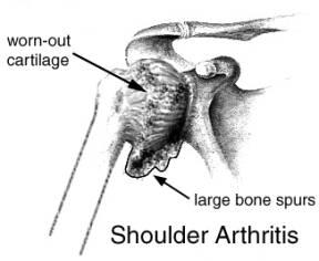 Shoulder Arthritis