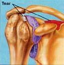 Rotator Cuff Tear Arthropathy Instability Breakdown of cartilage