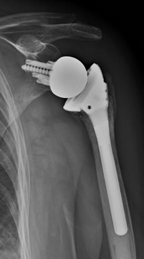 Reverse Older patients Poor bone quality Comminuted tuberosity Humeral head split Fracture dislocations