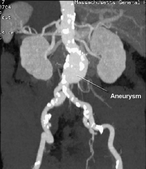 Isselbacher Aortic Aneurysms 825 Figure 12. Growth rates of small abdominal aortic aneurysms vs aneurysm size.