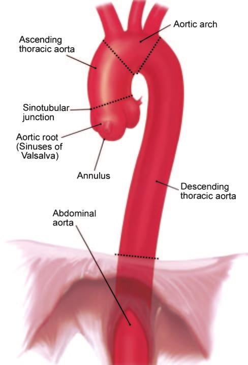 Isselbacher Aortic Aneurysms 817 Figure 1. Anatomy of thoracic and proximal abdominal aorta. ( Massachusetts General Hospital Thoracic Aortic Center. Used with permission.
