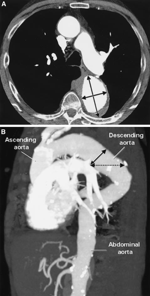 One option is to reconstruct the axial data into 3-dimensional images (ie, CT angiography), with which one can then measure the tortuous aorta in true cross section to obtain an accurate diameter