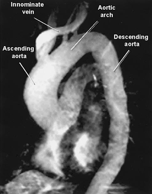 820 Circulation February 15, 2005 Figure 6. Composite aortic graft repair of aneurysm involving the aortic root and ascending thoracic aorta.
