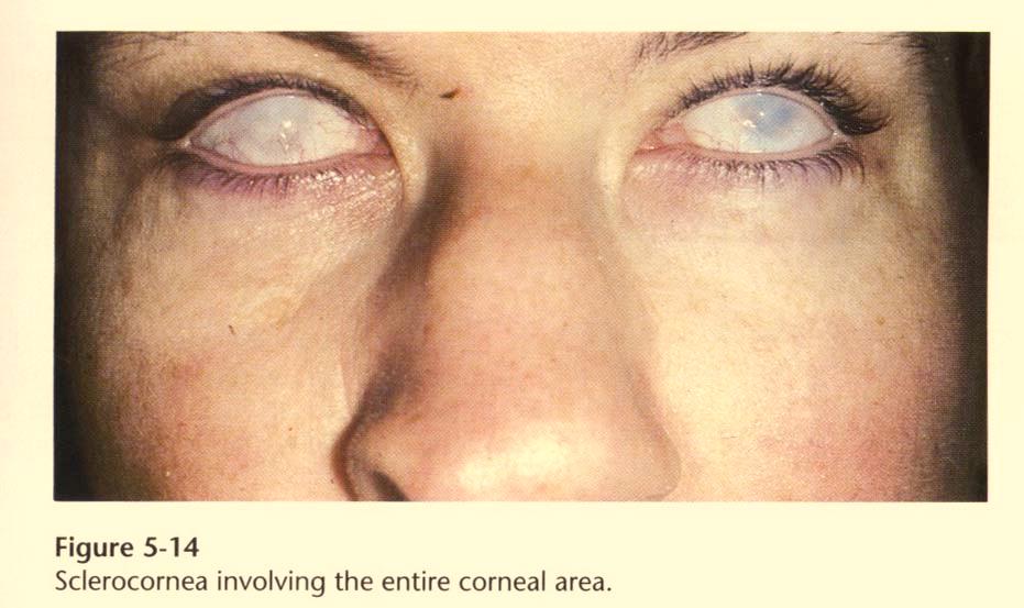 dermoids--overlapping the cornea and sclera, often inferotemporally Often