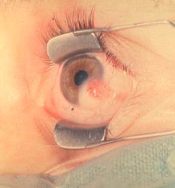 Degenerations Congenital Hereditary Endothelial Dystrophies-CHED (covered under Dystrophies), bilateral, diffuse corneal edema at birth or within a few of life Conditions with cloudy cornea at birth