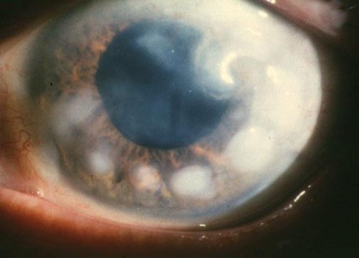 cornea, or no clear history of preceding eye