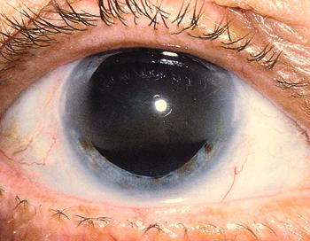 Band-Shaped Keratopathy Etiology: calcium salts which may occur from localized ocular inflammatory