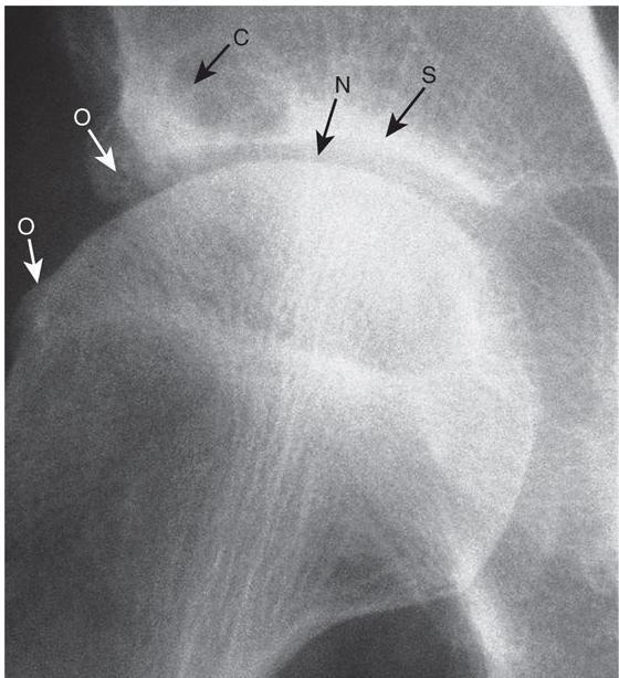 X-ray of hip showing changes of Osteoarthritis. Note the superior joint space narrowing (N), subchondral sclerosis (S), marginal osteophytes (white arrows) and cysts (C).