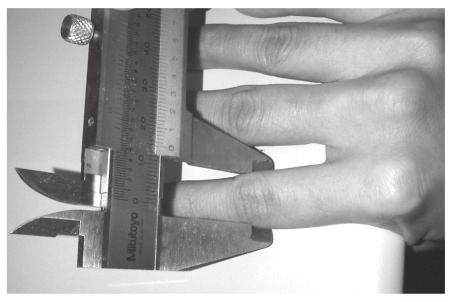 80 Figure 4. Measurement of 1 st metacarpal phalangeal jointûs width. Collecting data 1. Record the gender and stature of each sampleûs owner 2.