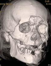 SIMPLE FRACTURES: NASAL BONES POOR IN COMPLEX INJURIES MANDIBULO- MODALITIES MRI NOT USED IN THE ACUTE SETTING COMPLEMENTARY IN UNEXPLAINED POST-TRAUMATIC