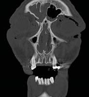 CENTRAL UPPER MIDFACE FRACTURE INVOLVING NOSE, ETHMOIDS AND MEDIAL