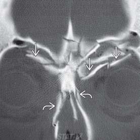 WHAT TO REPORT ON CT DEGREE OF COMMINUTION OF MEDIAL MAXILLARY BUTTRESS