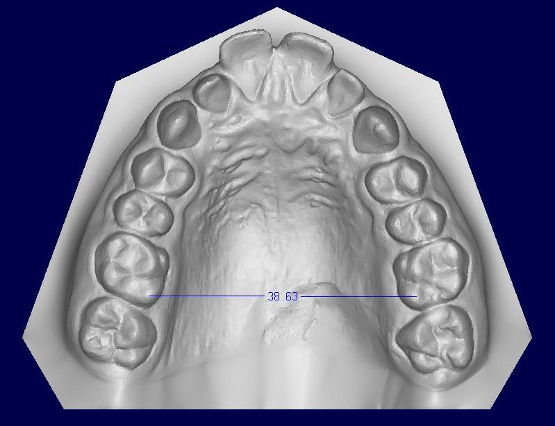26 Fig. 19. Measurement between distopalatal cusp tips of maxillary first molars on a digital dental model Fig.