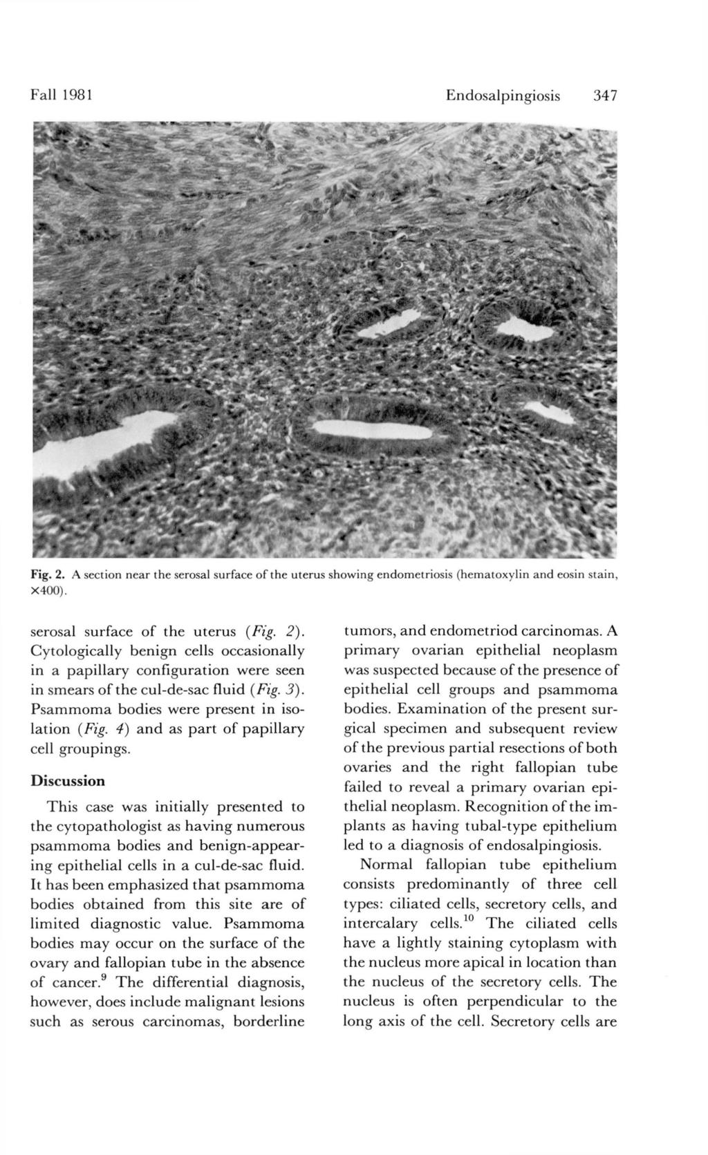 Fall 1981 Endosalpingiosis 347 Fig. 2. A section near the serosal surface of the uterus showing endometriosis (hematoxylin and eosin stain, X400). serosal surface of the uterus (Fig. 2).