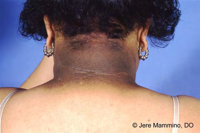 ACANTHOSIS NIGRICANS Develops mainly from high