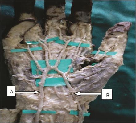 A physiologically complete palmar arch network is necessary for safe harvesting of the RA 7. The SPA is the center of attraction for most of the procedures and traumatic events in the hand.