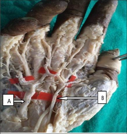 5: Ulnar- median palmar type of SPA A-Ulnar artery; B Radial artery; C- Median artery Ulnar +median +1 st dorsal