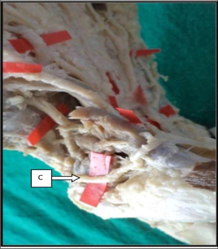 56%) (Fig 6) Arch is formed by superficial branch of ulnar artery and, persistent median artery.