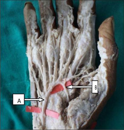 Ulnar + proper radial +1 st dorsal metacarpal artery in 4 hands (2.