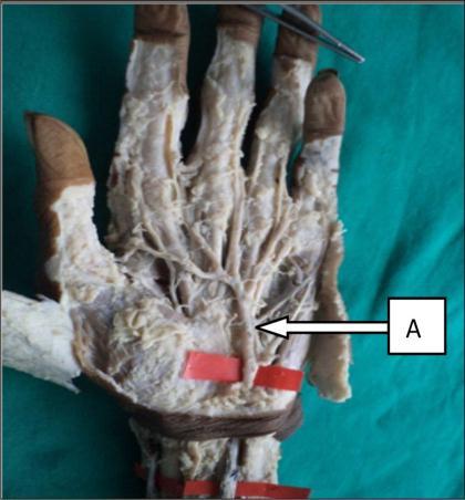 13%) (Fig 16) In this subtype superficial branch of ulnar artery and superficial branch of radial artery enter the palm, ulnar artery supplies major portion of hand while