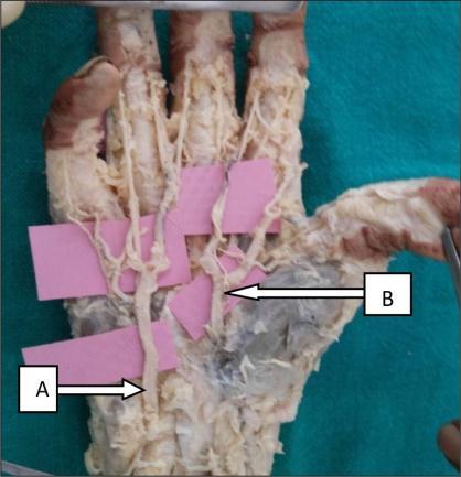Fig 13: dorsal view: 1 st dorsal metacarpal artery C- 1 st dorsal metacarpal artery Non arch type further classified in to following subtypes: dominant ulnar type and