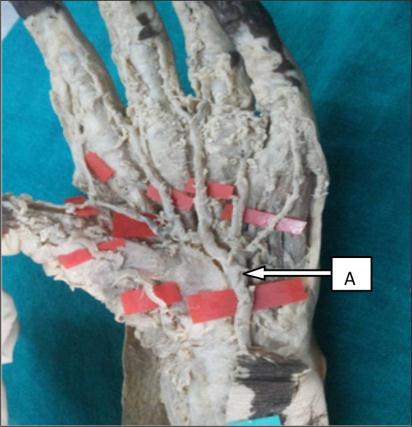 Fig 16: Arch formed by ulnar artery only A- Ulnar artery 3. Ulnar + superficial radial +1 st palmar metacarpal artery in 2 hands (1.